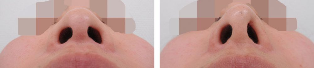 鼻尖4Dノーズ/鼻尖形成・鼻尖縮小の症例写真 施術前後 直後