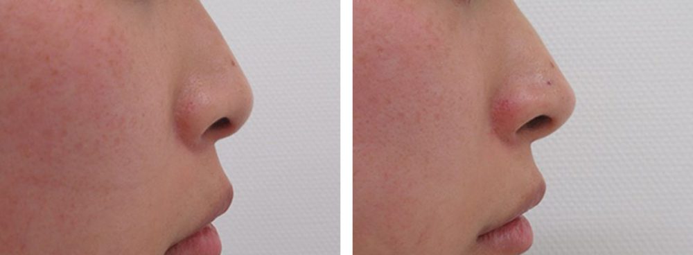 鼻尖4Dノーズ/鼻尖形成・鼻尖縮小の症例写真 施術前後 直後