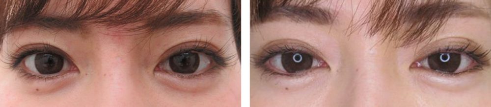 切らないグラマラスライン形成の症例です