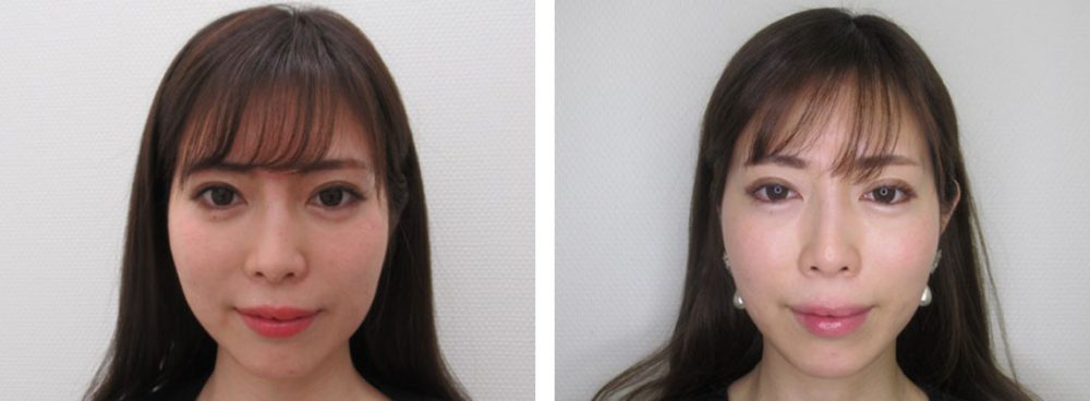 TAC式糸リフトはお肌も綺麗になります