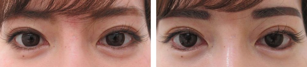 グラマラスライン（タレ目形成）の症例写真 施術前後 １週間