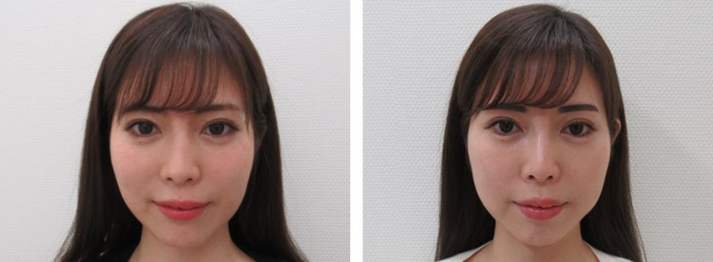 TAC式 ツヤ肌コラーゲンリフト®の症例写真 施術前後 １週間