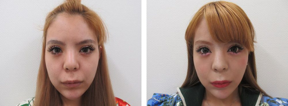 神田まや様の輪郭施術後３週間経過です