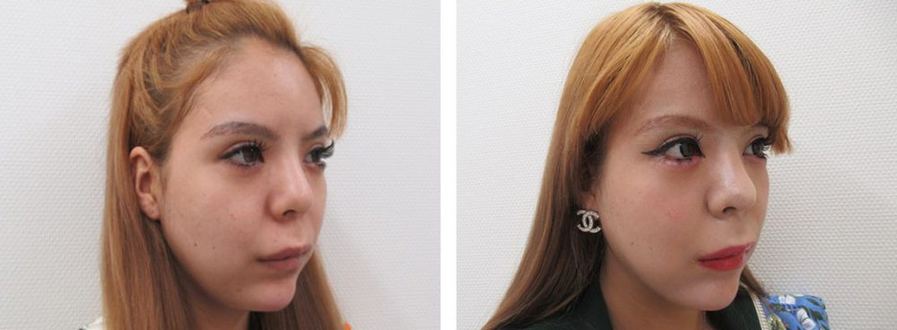 TAC式 ツヤ肌コラーゲンリフト®/バッカルファット除去/顔の脂肪吸引の症例写真 施術前後 ３週間