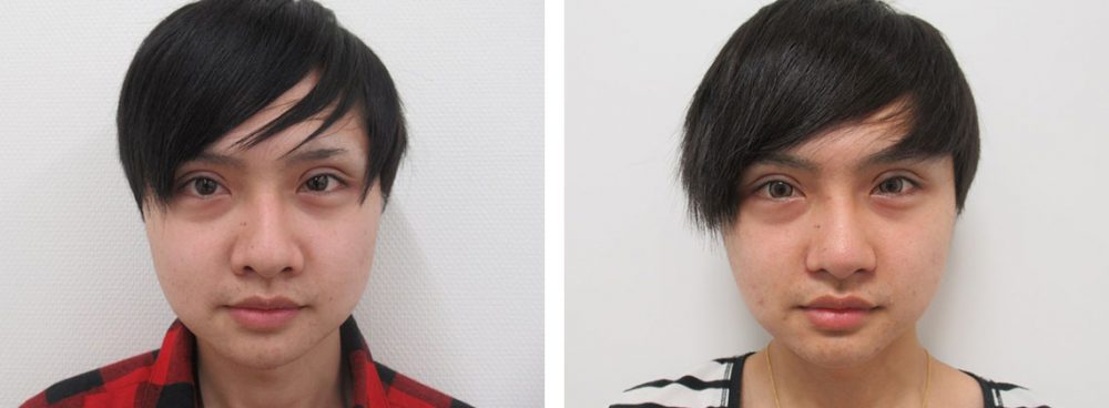 鼻のヒアルロン酸注射/鼻尖形成・鼻尖縮小/鼻尖4Dノーズの症例写真 施術前後 1ヵ月