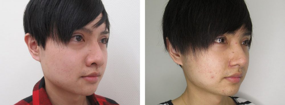 鼻のヒアルロン酸注射/鼻尖形成・鼻尖縮小/鼻尖4Dノーズの症例写真 施術前後 1ヵ月