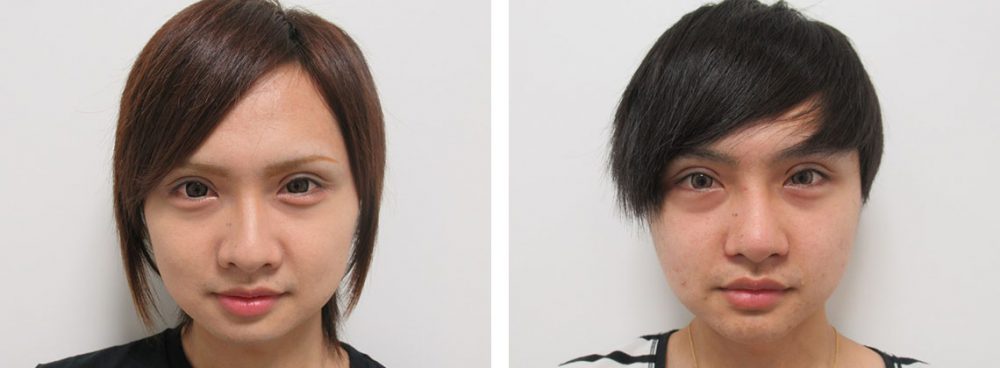 あきたん様の輪郭とお鼻の術後経過です