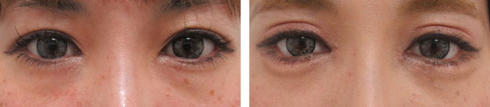 二重切開(全切開法)/グラマラスライン(タレ目形成)/目頭切開術の症例写真 施術前後 1ヵ月(化粧有り)