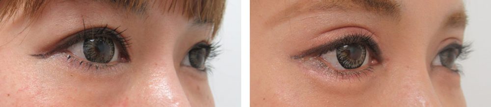 二重切開(全切開法)/グラマラスライン(タレ目形成)/目頭切開術の症例写真 施術前後 1ヵ月(化粧有り)