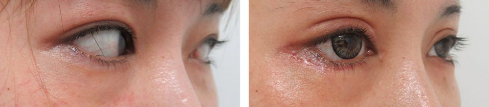 二重切開(全切開法)/グラマラスライン(タレ目形成)/目頭切開術の症例写真 施術前後 1ヵ月(化粧無し)