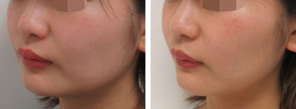 TAC式 ツヤ肌コラーゲンリフト®の症例写真 施術前後 １ヵ月