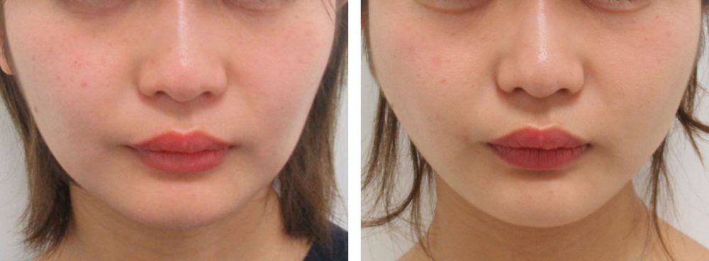 TAC式 ツヤ肌コラーゲンリフト®の症例写真 施術前後 １週間