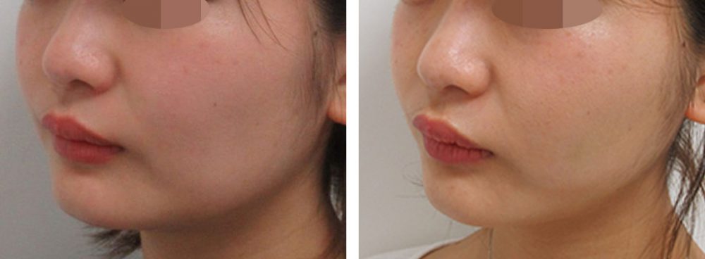 TAC式 ツヤ肌コラーゲンリフト®の症例写真 施術前後 １週間