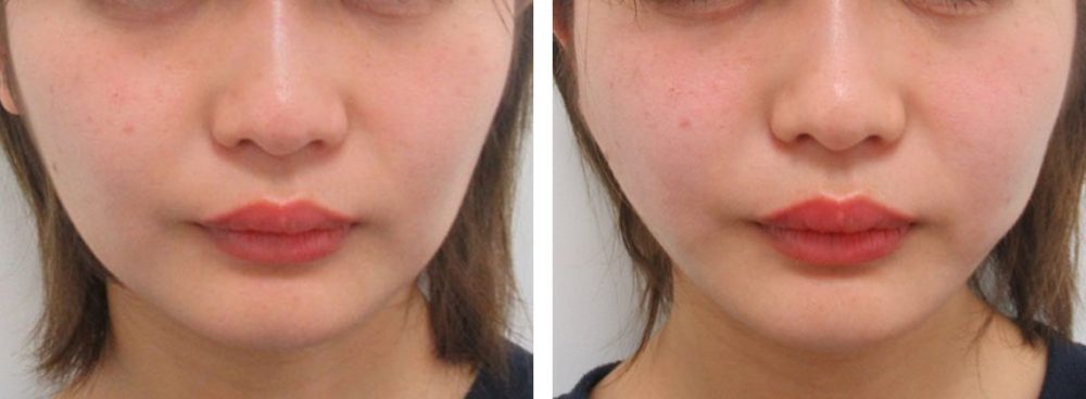 TAC式 ツヤ肌コラーゲンリフト®の症例写真 施術前後 直後