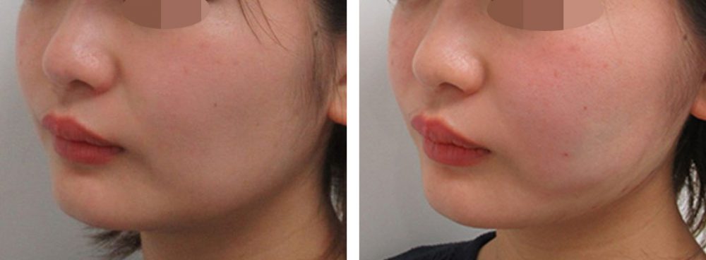TAC式 ツヤ肌コラーゲンリフト®の症例写真 施術前後 直後