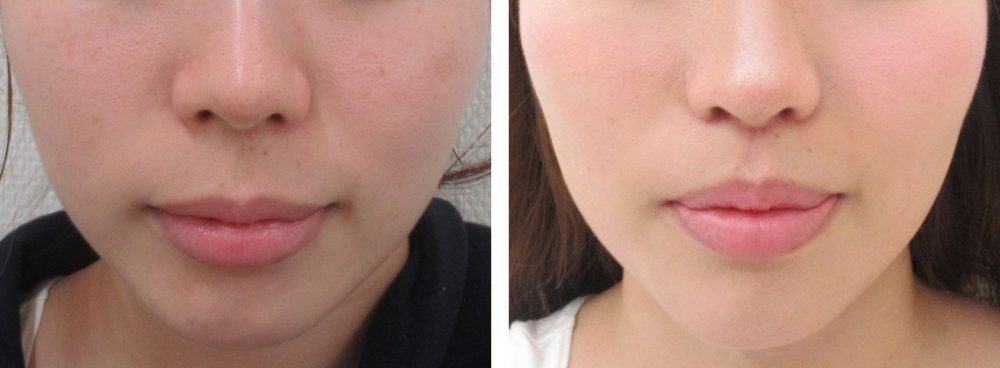 ２つの施術を組み合わせて鼻の下を短くする