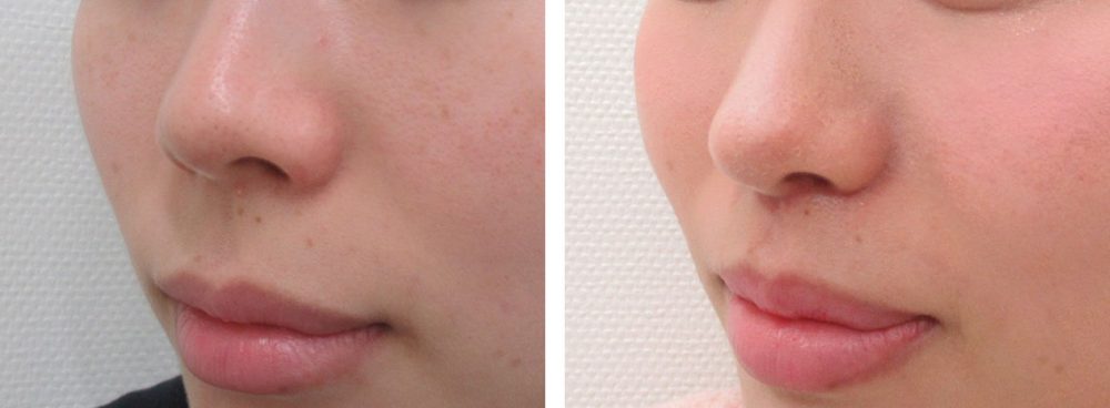 人中短縮術(リップリフト)・外側人中短縮術/鼻尖4Dノーズの症例写真 施術前後 １ヵ月