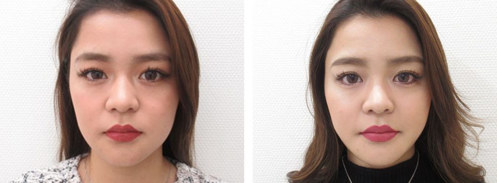 滑らかなフェイスラインに変わりました