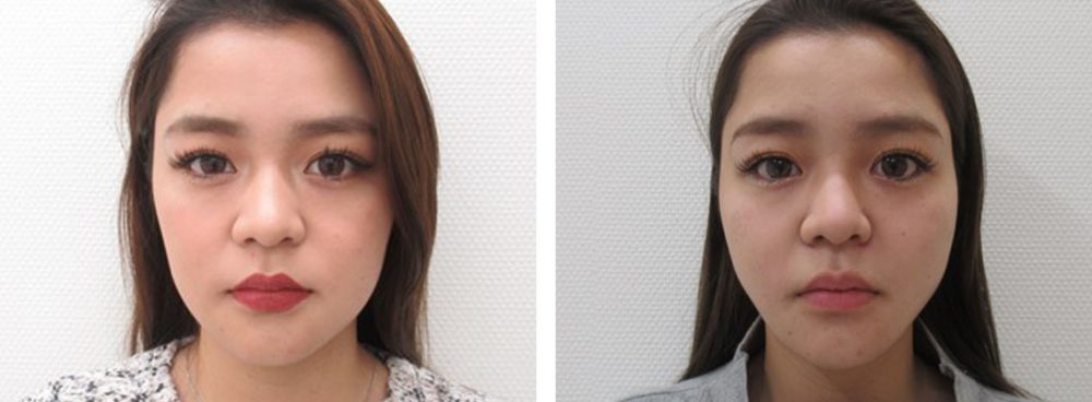 TAC式 ツヤ肌コラーゲンリフト®/ボトックス注射：その他の症例写真 施術前後 １週間