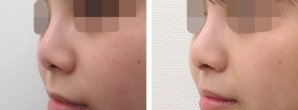 他院鼻の全体的な修正