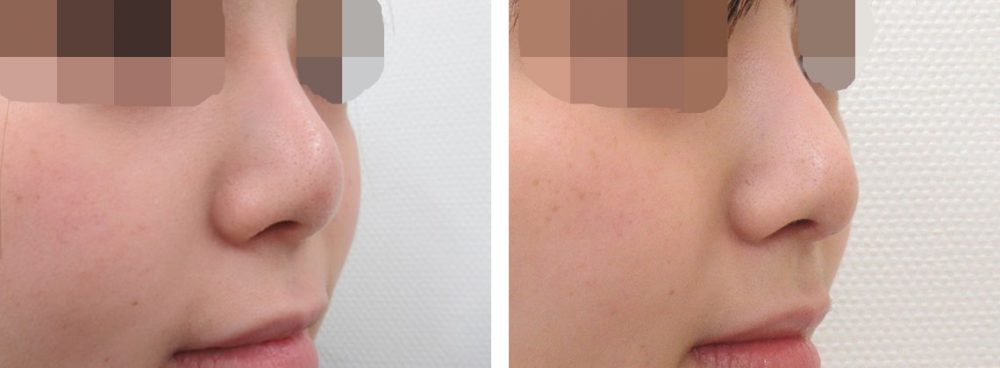 隆鼻術（プロテーゼ・自家組織）/鼻中隔延長術の症例写真 施術前後 １ヵ月