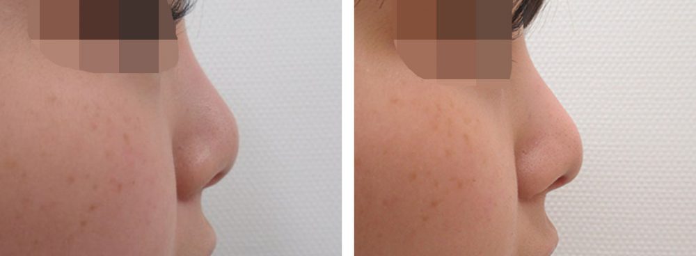 隆鼻術（プロテーゼ・自家組織）/鼻中隔延長術の症例写真 施術前後 １ヵ月