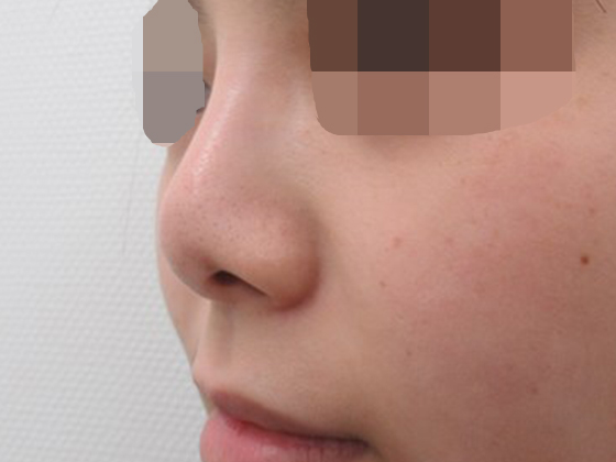 他院鼻の全体的な修正 症例写真 Taクリニック 美容整形 美容外科 新宿 銀座 大阪 福岡 高崎