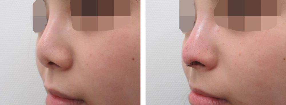 隆鼻術（プロテーゼ・自家組織）/鼻中隔延長術の症例写真 施術前後 直後