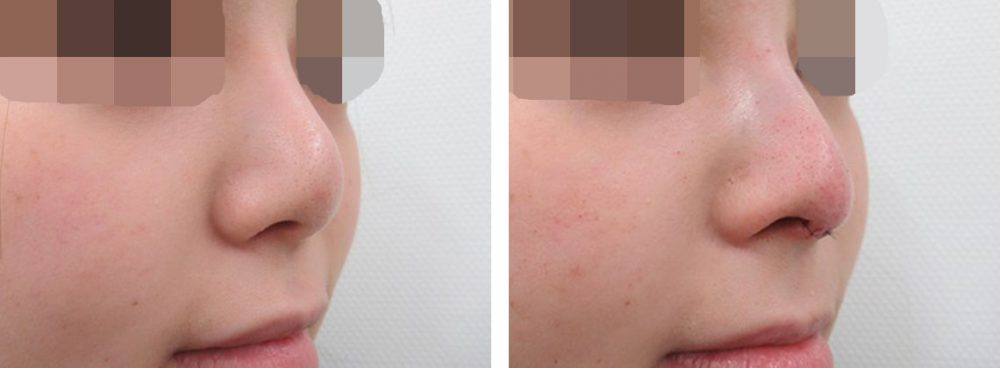 隆鼻術（プロテーゼ・自家組織）/鼻中隔延長術の症例写真 施術前後 直後