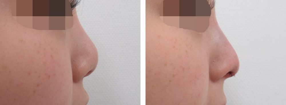 隆鼻術（プロテーゼ・自家組織）/鼻中隔延長術の症例写真 施術前後 直後