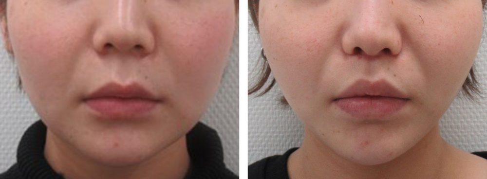 糸のリフトアップ術とボトックス注射の組み合わせは効果抜群です