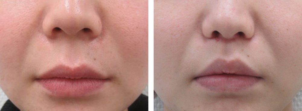 TAC式 ツヤ肌コラーゲンリフト®/ボトックス注射：その他/人中短縮術(リップリフト)・外側人中短縮術の症例写真 施術前後 １ヵ月