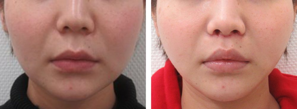 TAC式 ツヤ肌コラーゲンリフト®/ボトックス注射：その他/人中短縮術(リップリフト)・外側人中短縮術の症例写真 施術前後 １週間