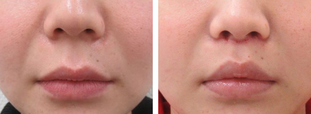 TAC式 ツヤ肌コラーゲンリフト®/ボトックス注射：その他/人中短縮術(リップリフト)・外側人中短縮術の症例写真 施術前後 １週間