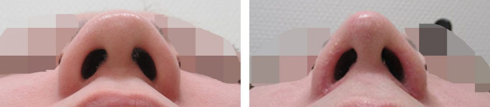 鼻尖4Dノーズ/鼻孔縁挙上術/鼻尖形成・鼻尖縮小の症例写真 施術前後 1ヵ月