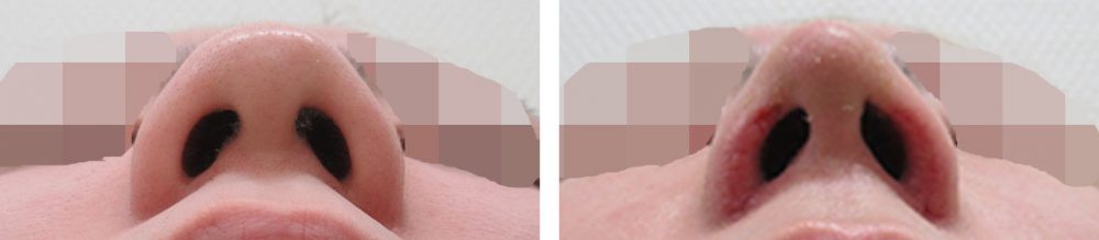 鼻尖4Dノーズ/鼻孔縁挙上術/鼻尖形成・鼻尖縮小の症例写真 施術前後 1週間