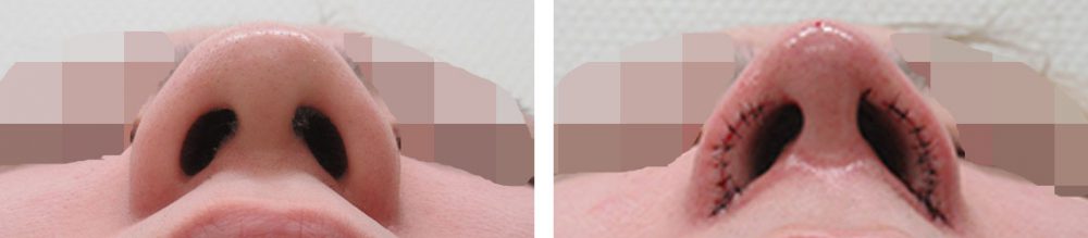 鼻尖4Dノーズ/鼻孔縁挙上術/鼻尖形成・鼻尖縮小の症例写真 施術前後 直後