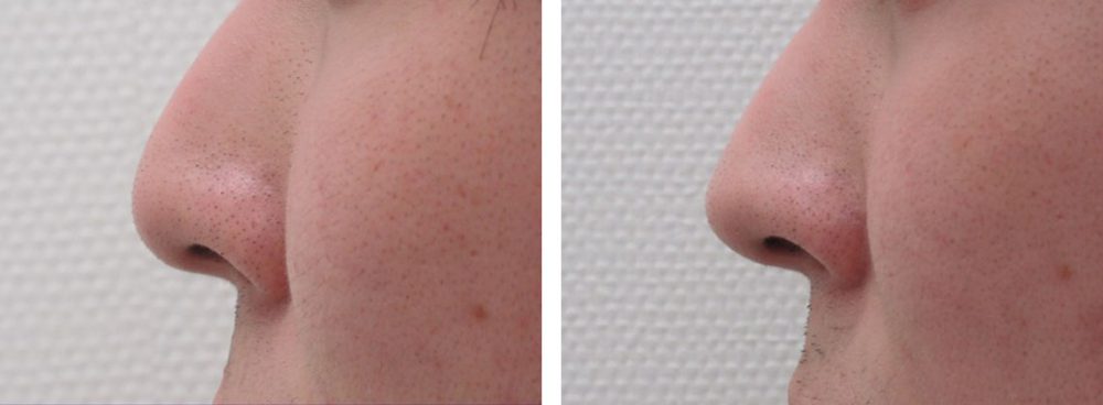 鼻尖４Dノーズだけでもお鼻の印象は変わります