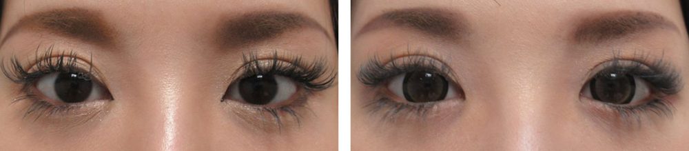 目尻靭帯移動術でコンプレックス解消