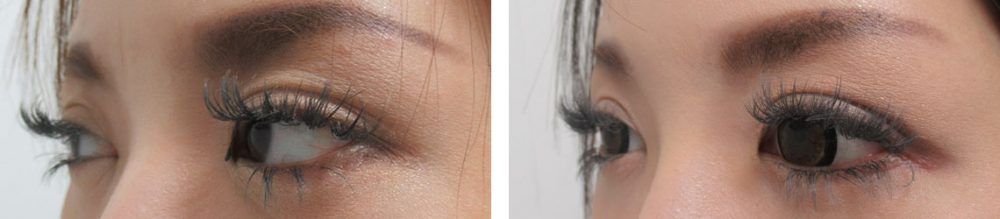 目尻靭帯移動術の症例写真 施術前後 １ヵ月