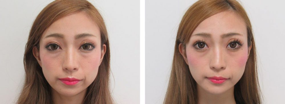 TAC式ツヤ肌コラーゲンリフトでさらに小顔に