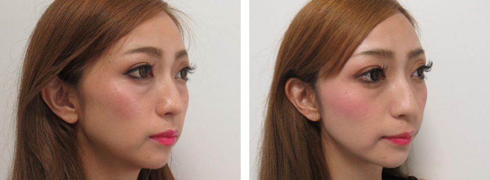 TAC式 ツヤ肌コラーゲンリフト®/ボトックス注射：その他の症例写真 施術前後 １ヵ月