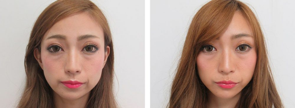 TAC式 ツヤ肌コラーゲンリフト®/ボトックス注射：その他の症例写真 施術前後 １週間