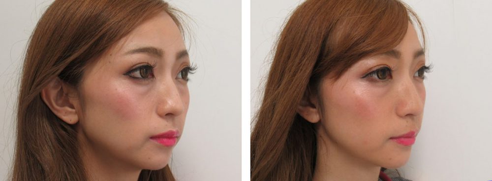 TAC式 ツヤ肌コラーゲンリフト®/ボトックス注射：その他の症例写真 施術前後 １週間