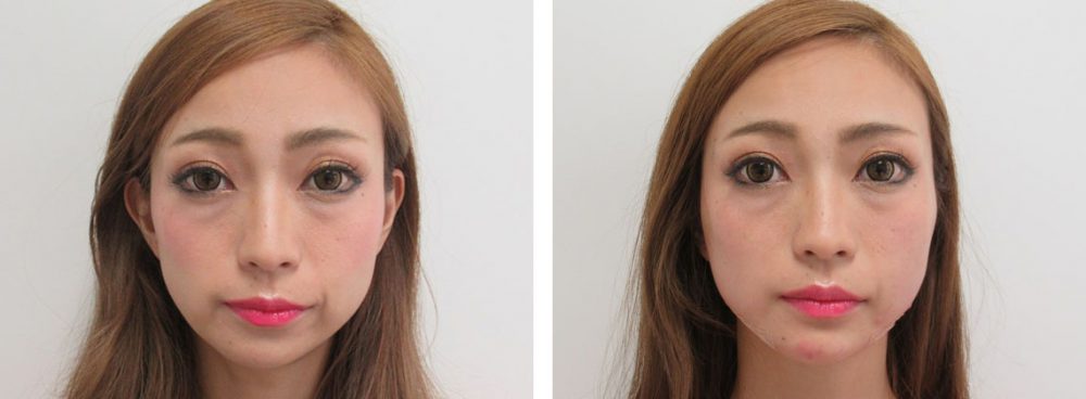 TAC式 ツヤ肌コラーゲンリフト®/ボトックス注射：その他の症例写真 施術前後 直後