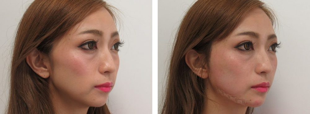 TAC式 ツヤ肌コラーゲンリフト®/ボトックス注射：その他の症例写真 施術前後 直後