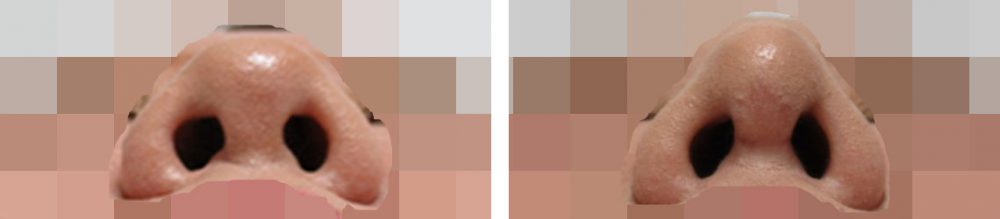 隆鼻術（プロテーゼ・自家組織）/鼻尖4Dノーズ/鼻尖形成・鼻尖縮小の症例写真 施術前後 １ヵ月