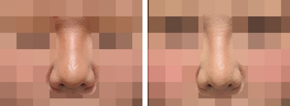 隆鼻術（プロテーゼ・自家組織）/鼻尖4Dノーズ/鼻尖形成・鼻尖縮小の症例写真 施術前後 １ヵ月