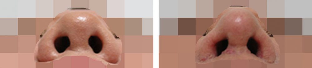 隆鼻術（プロテーゼ・自家組織）/鼻尖4Dノーズ/鼻尖形成・鼻尖縮小の症例写真 施術前後 ３ヵ月