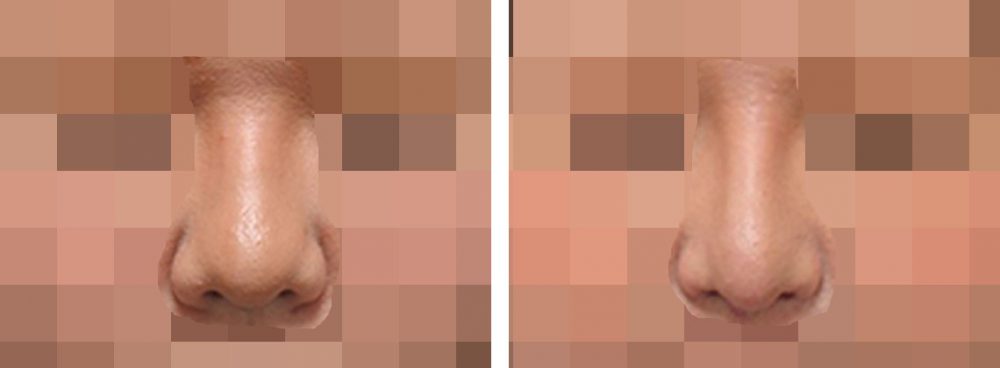隆鼻術を用いて整ったお鼻に仕上げました